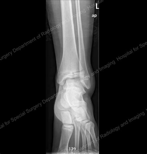 Ankle Fracture X Ray