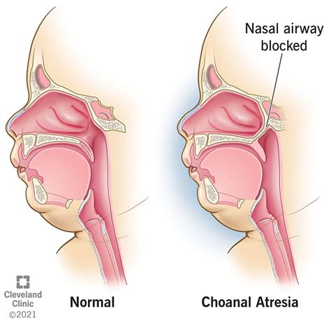 Choanal Atresia Mis See On Sümptomid Ravi Ja Parandamine SFOMC