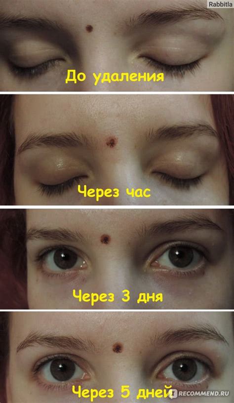 Можно ли удалять выпуклые родинки на лице: какие нужно и опасно ли лазером?
