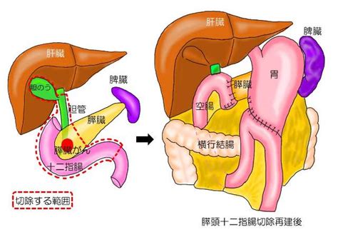 膵頭十二指腸切除術とは？｜医学的見地から