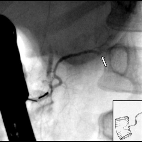 Endoscopic Retrograde Cholangio Pancreatogram With Opacification Of The