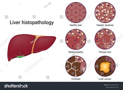 Leberhistopathologie Gesunde Leber Hepatosteatose Steatohepatitis