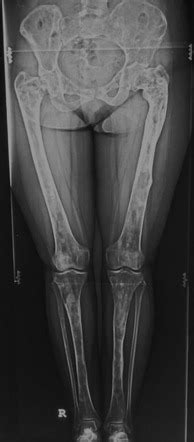 Polyostotic fibrous dysplasia | Radiology Case | Radiopaedia.org