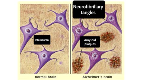 Amyloid Plaques And Neurofibrillary Tangles By Ella Rankin On Prezi