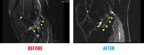 Knee MRI - Regenexx