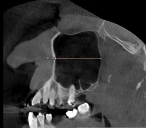 Measurement Of The Anteroposterior Dimension Of The Maxillary Sinus