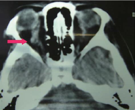 Figure 4 From Septic Cavernous Sinus Thrombosis Complicated By Narrowing Of The Internal Carotid