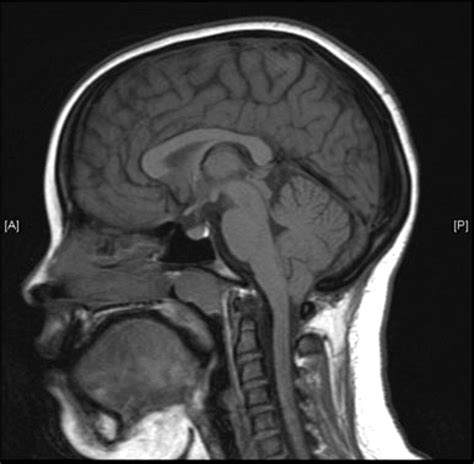 Arnold Chiari Malformation Type 2 Mri