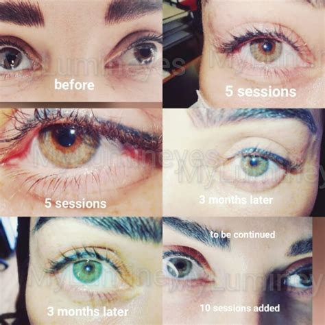 Laser Eye Color Change Before And After