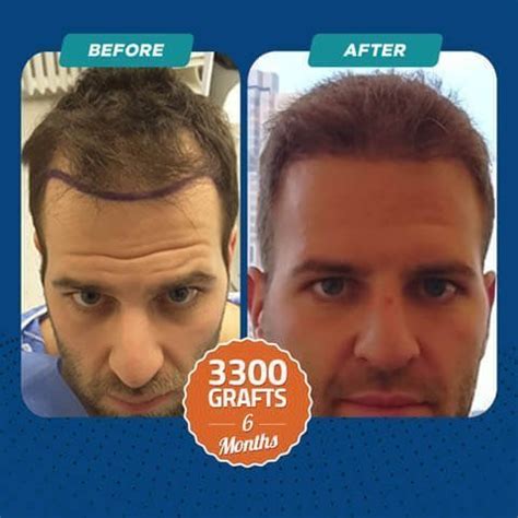 Hair Transplant Without Shaving In Turkey DR CELEN