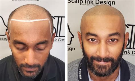 Scalp Micropigmentation is a non-surgical hair loss treatment | Scalp ...