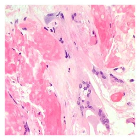 Foreign Body Giant Cell Reaction To The Keratin Hande ×400 A And ×600