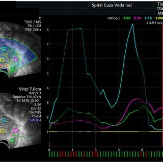 Cervical Elastography With The Measurement Of The Strain Ratio After 5