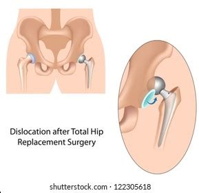 Dislocation After Hip Replacement Surgery Stock Vector (Royalty Free ...