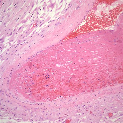 Chapter Placental Perfusion Section A Spiral Arteries Obstetrical