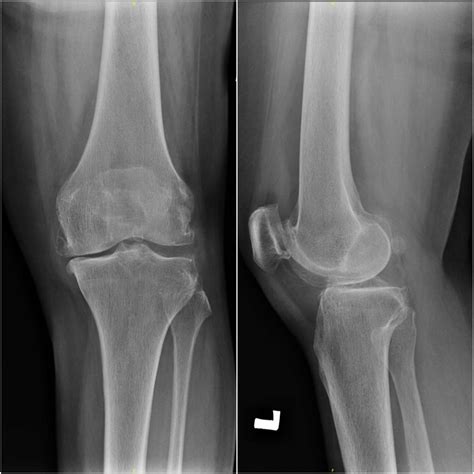 Preoperative Standing Antero Posterior And Lateral Radiographs Of The Download Scientific