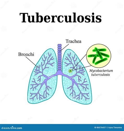 The Process Of Tuberculosis Formation Infographics Vector