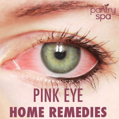 7 Conjunctivitis Home Remedies & Pink Eye Natural Treatments