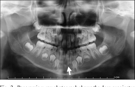 Figure 2 from Dens evaginatus and dens invaginatus in a mandibular ...