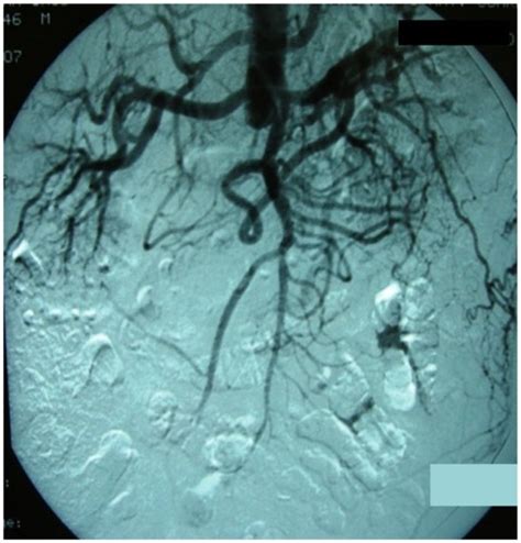 Full Article Axillofemoral Bypass With Local Anesthesia A Way Forward To Enable Limb Salvage