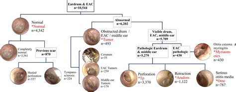 Normal Tympanic Membrane Labeled