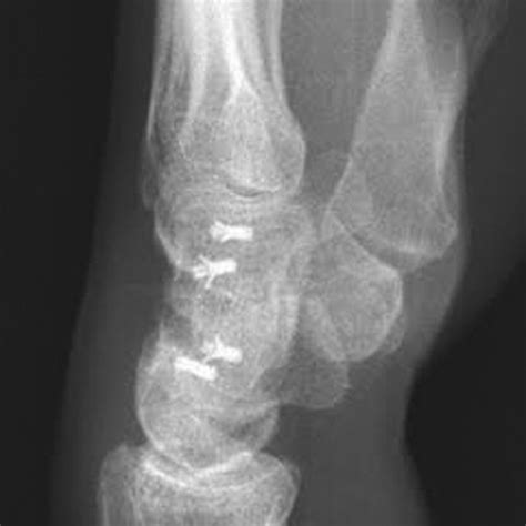 Postoperative Posteroanterior Radiograph Of The Wrist Showing The Final