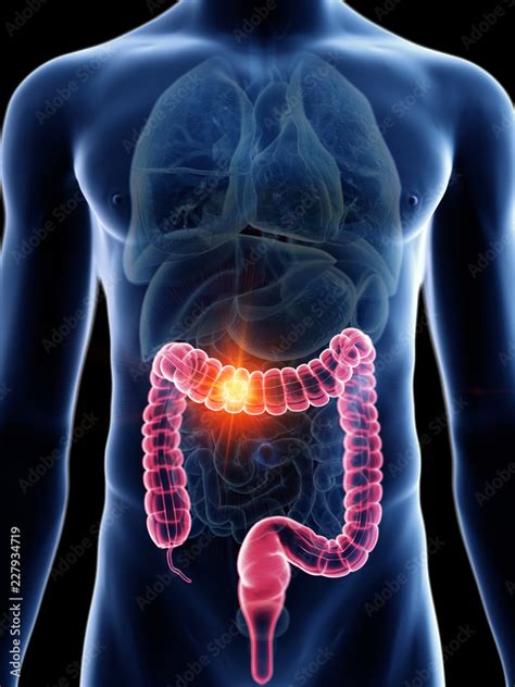 3d Rendered Medically Accurate Illustration Of A Mans Colon Cancer Stock イラスト Adobe Stock