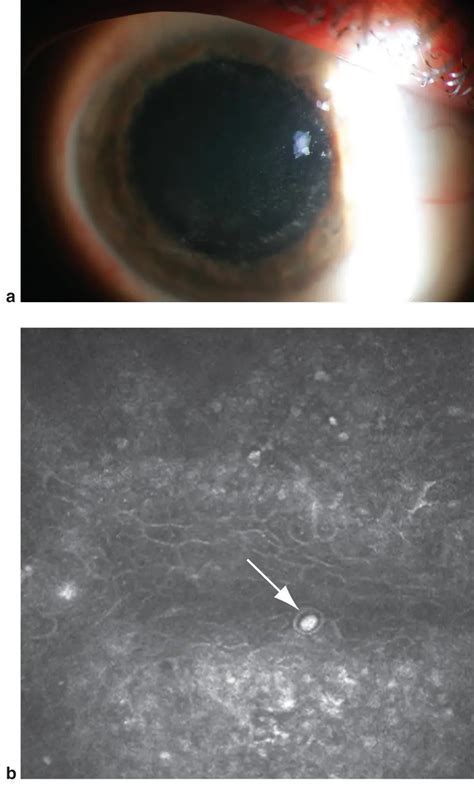 Acanthamoeba Keratitis American Academy Of Ophthalmology