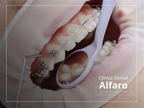 Ortodoncia Convencional Brackets Met Licos Cl Nica Dental Alfaro