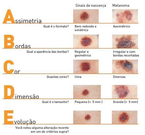 Dra Melissa Bristot Dermatologista C Ncer De Pele