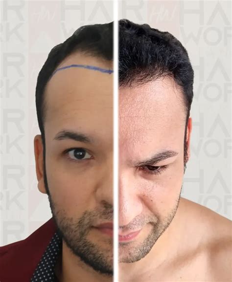 Hair Transplant Istanbul Hair Work Istanbul