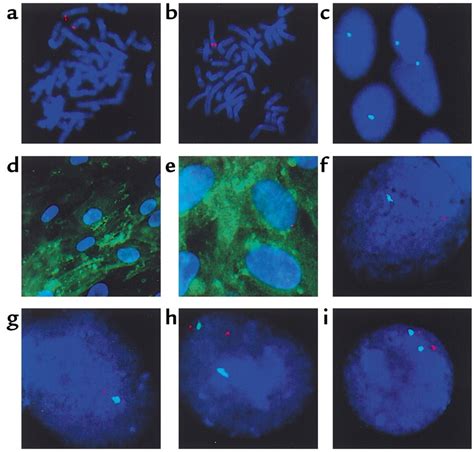 Detection Of Dystrophin Exon Deletion In Dmd Bmt And His Mother By