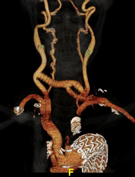 A Prebifurcated Axillobifemoral Polytetrafluoroethylene Graft Simplifies Carotid To Carotid To