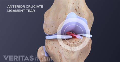 Anterior Cruciate Ligament Acl Injuries