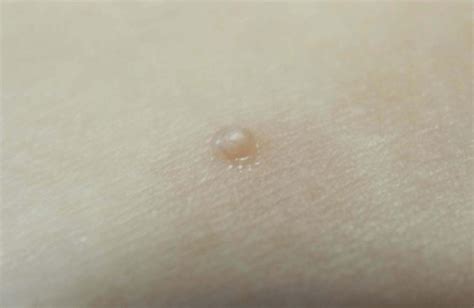 Firm Rounded Skin Colored Papules With A Shiny And Umbilicated