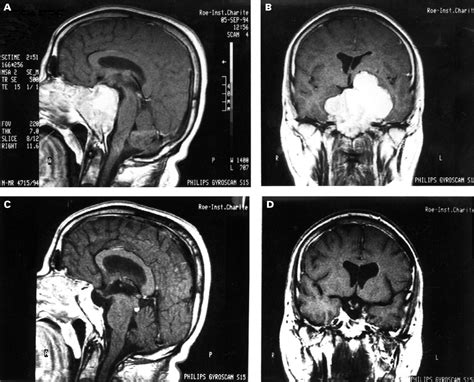 A “giant” Prolactinoma Journal Of Neurology Neurosurgery And Psychiatry