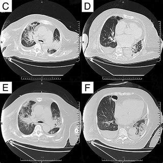 Chest Computed Tomography Findings In Case Which Were Examined At