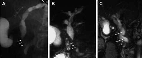 A Endoscopic Cholangiography Shows Common Bile Duct Stricture