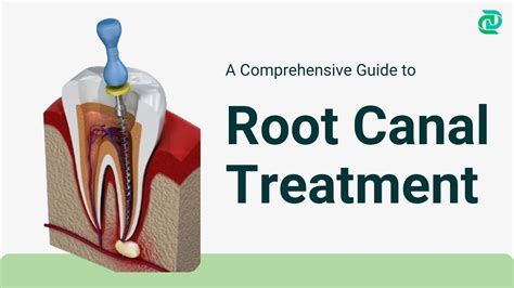 A Comprehensive Guide to Root Canal Treatment