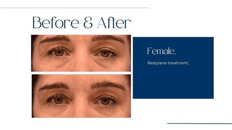 RESTYLANE® Before & After Gallery - Austin, TX: Balcones Dermatology & Aesthetics