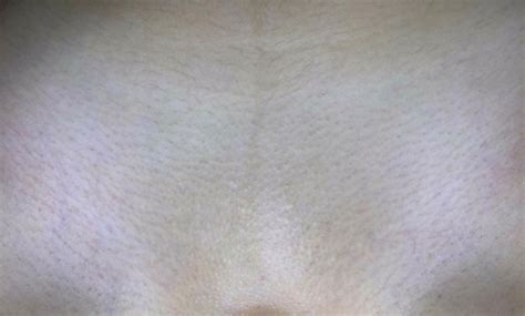 Depilacja laserowa bikini ᐈ Warszawa