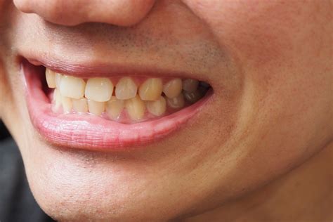 Stained Teeth After Braces Treatment