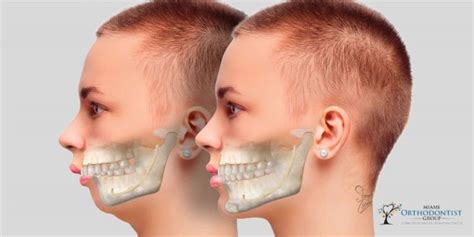 Enhancing Oral Health The Role Of Orthognathic Surgery In Treating