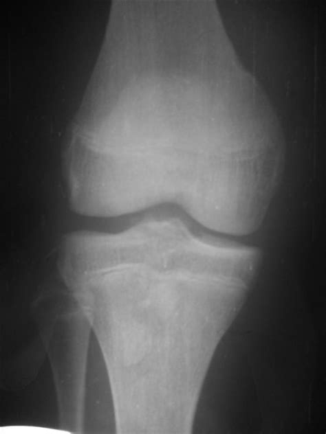 Tibial Intercondylar Eminence