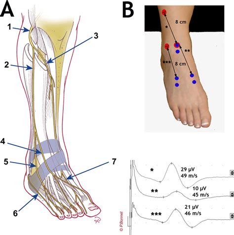 A Branches Du Nerf Fibulaire Commun Nerf Fibulaire Commun