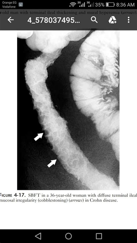 #cobblestoning | Radiología, Abdomen