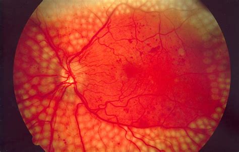 Diabetic Retinopathy: Symptoms, Prevention and Treatment