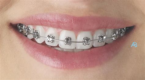 Braces Ace Braces Oregan Orthodontics Teeth Straightening Ireland