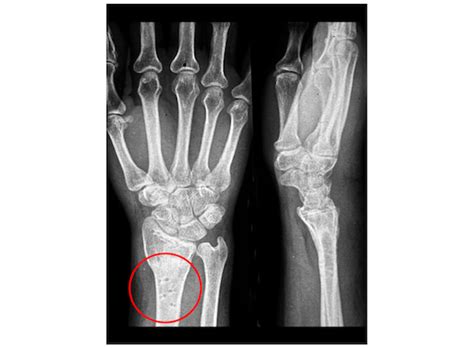 Wrist Osteoarthritis