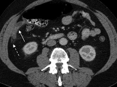 The Appendix | Radiology Key